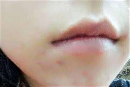 長痘痘