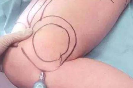 減肥