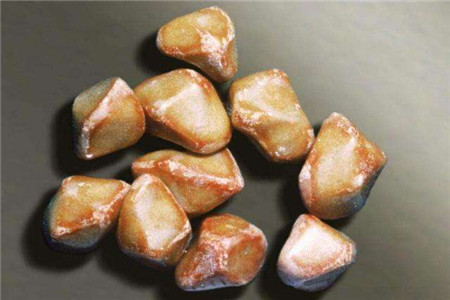 膽結(jié)石